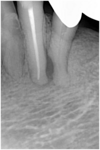 斎藤1　歯髄壊死　◎